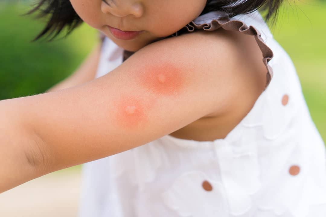alergia al veneno de insectos