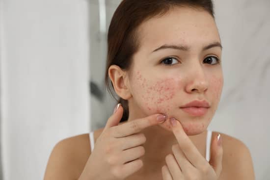 acne mujer